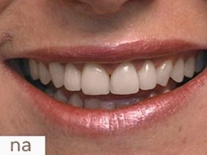 Paine Gillic Computerspelletjes spelen Portiek Bleken van tanden voor een mooie glimlach