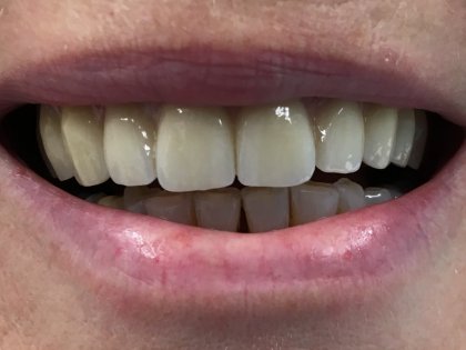 Vervangen van alle tanden na tandvleesproblemen door prothetisch herstel