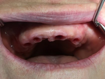 Vervangen van alle tanden na tandvleesproblemen door prothetisch herstel